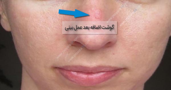 گوشت اضافه بعد عمل بینی