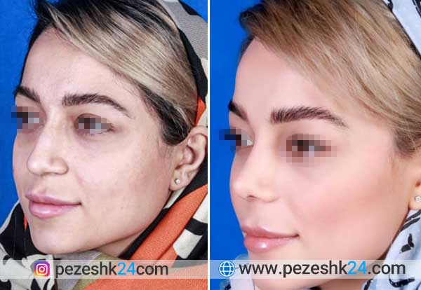 نمونه کارهای دکتر غلامی جراح بینی مشهد