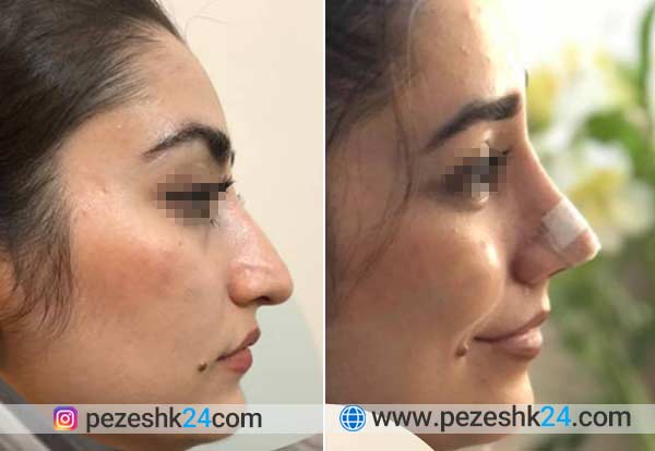 نمونه عمل بینی دکتر کیانوش ناهید