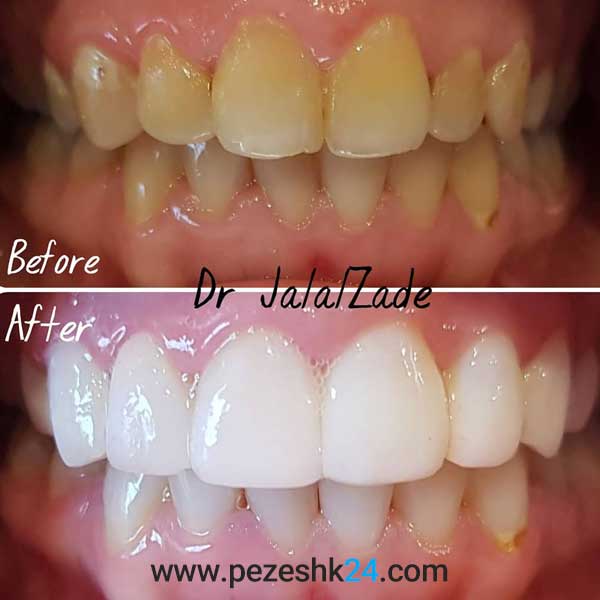 نمونه بلیچینگ دندان دکتر جلال زاده 1