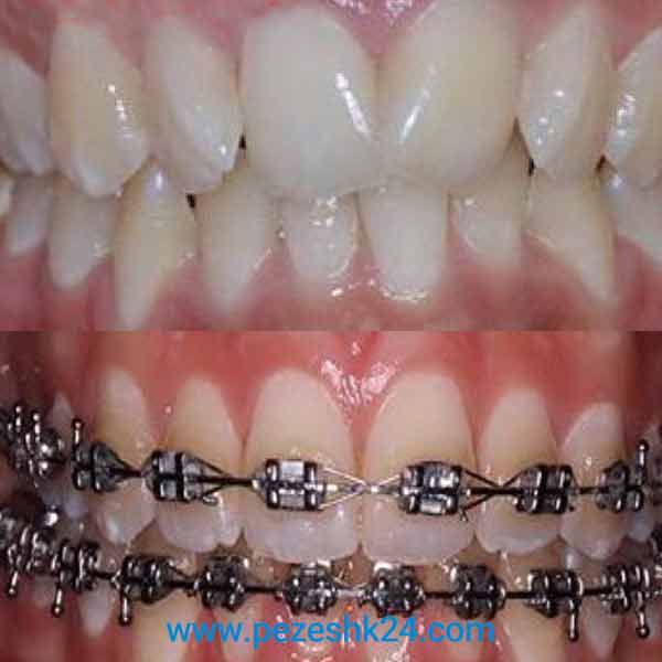 نمونه کار ارتودنسی دندان دکتر ایزدپناه 1