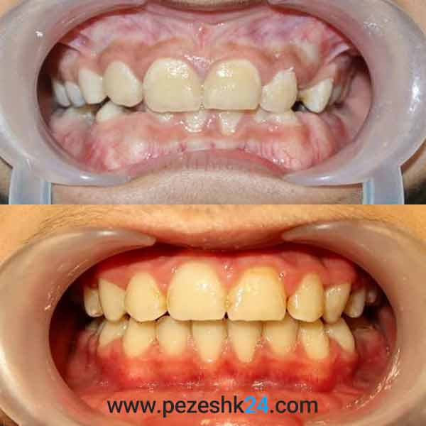 نمونه کار ارتودنسی دندان دکتر مینا 2