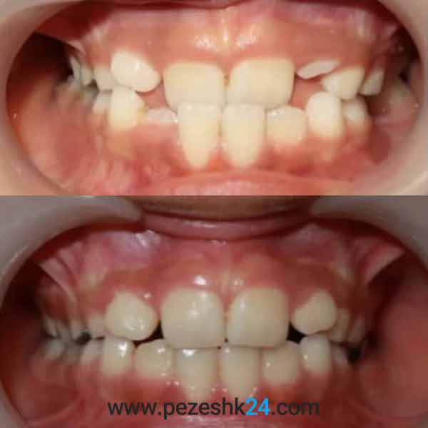نمونه کار ارتودنسی دندان دکتر مینا 4