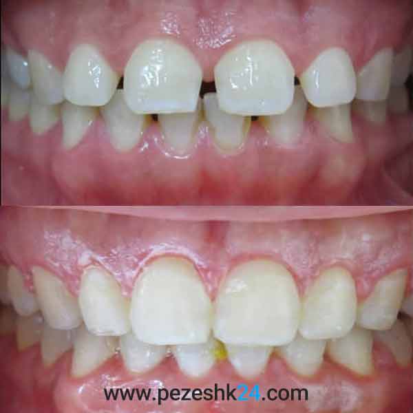 نمونه کار ارتودنسی دندان دکتر زارع 3
