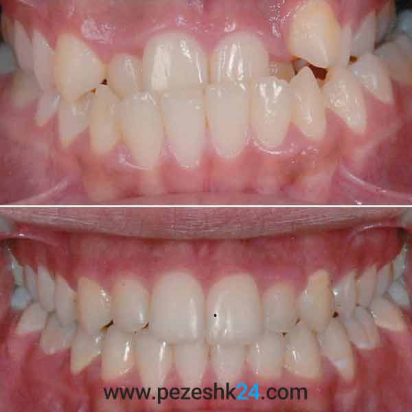 نمونه کار ارتودنسی دندان دکتر ظریف 1