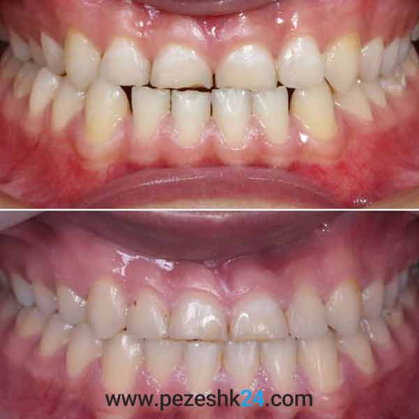 نمونه کار ارتودنسی دندان دکتر ظریف 2