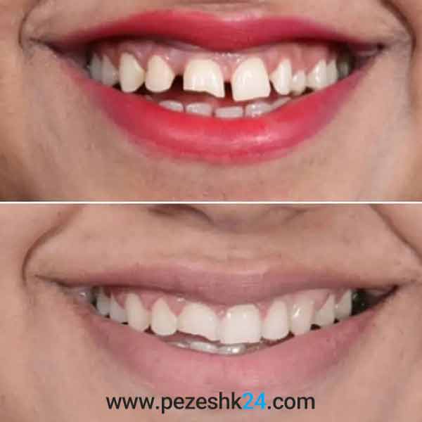 نمونه کار ارتودنسی دندان دکتر ظریف 4