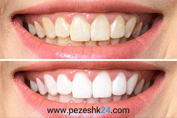 نمونه پالیش کامپوزیت دندان 1