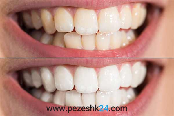 نمونه پالیشینگ کامپوزیت