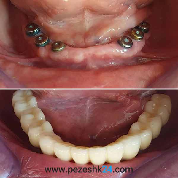 نمونه ایمپلنت دکتر نصر 1