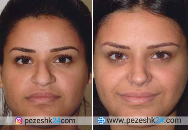 نمونه جراحی بینی گوشتی در همدان