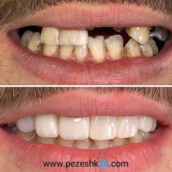 نمونه لمینت دندان دکتر سروستانی شیراز 3