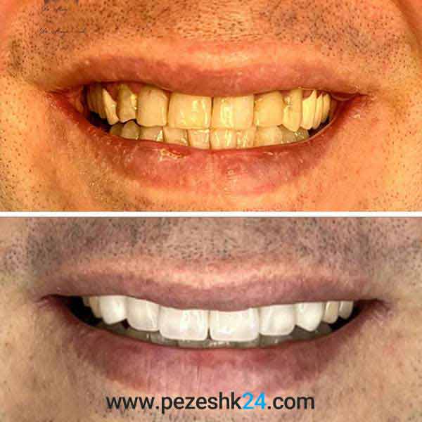نمونه لمینت دندان دکتر امیدی شیراز 11