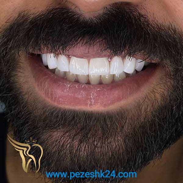 نمونه لمینت دندان دکتر امیدی 12