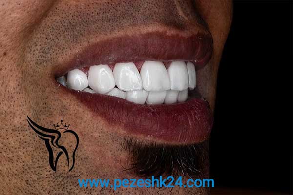 نمونه لمینت دندان دکتر امیدی در شیراز 3