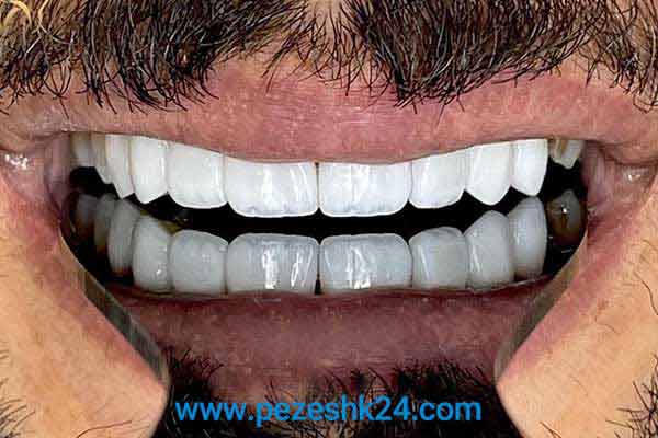 نمونه لمینت دندان دکتر امیدی 13