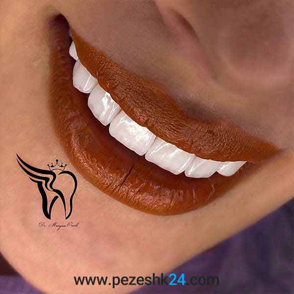 نمونه لمینت دندان دکتر امیدی 14