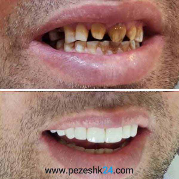 نمونه لمینت دندان دکتر سروستانی شیراز 1