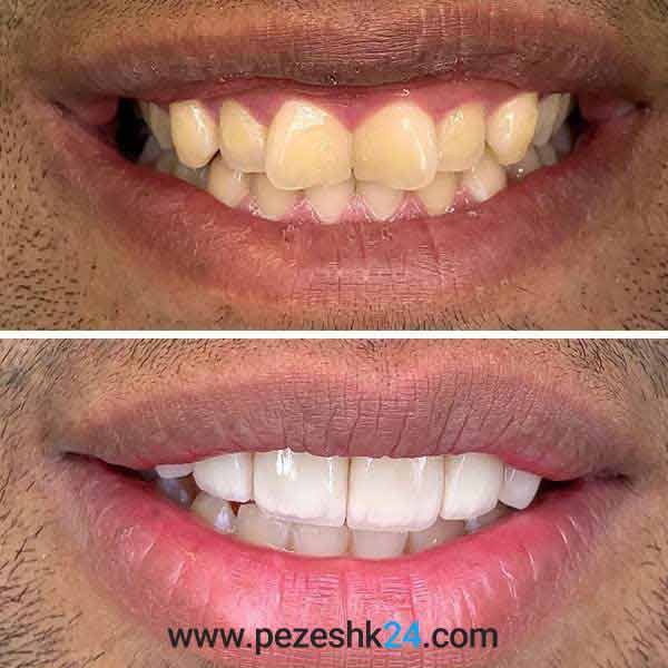 نمونه لمینت دندان دکتر سروستانی شیراز 2