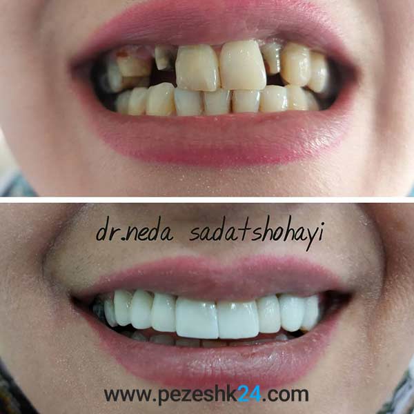 نمونه لمینت دکتر شجاعی شیراز 1