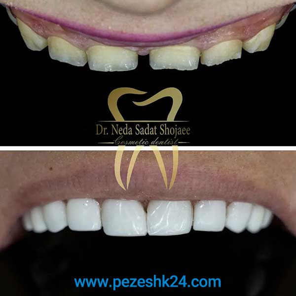 نمونه لمینت دکتر شجاعی شیراز 3