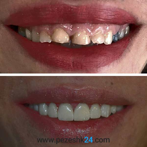 نمونه لمینت دندان دکتر سلطانی در شیراز 1