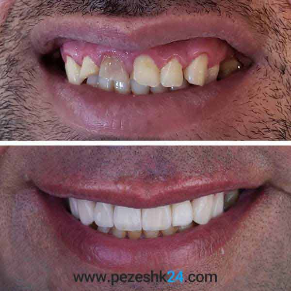 نمونه لمینت دندان دکتر سلطانی 2