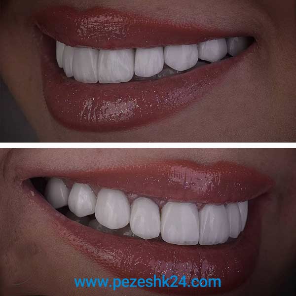 نمونه لمینت دندان دکتر سلطانی در شیراز 3