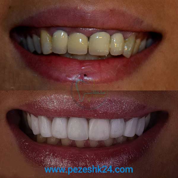 نمونه لمینت دندان دکتر سلطانی در شیراز 4