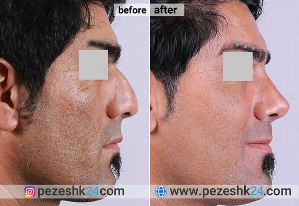 عکس قبل و بعد عمل بینی دکتر مرتضی رضایی جراح بینی اهواز