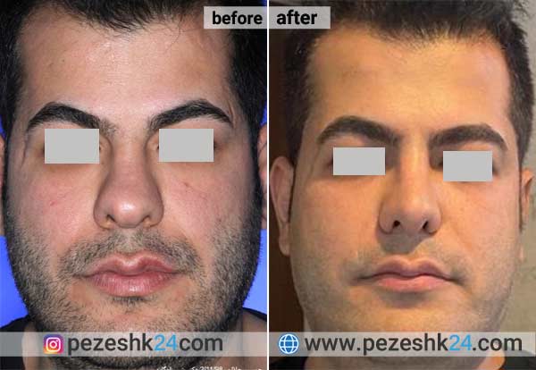 عکس قبل و بعد عمل بینی دکتر شیرزادگان اهواز