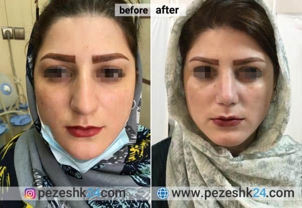 عکس قبل و بعد عمل بینی دکتر صادق منش یزد
