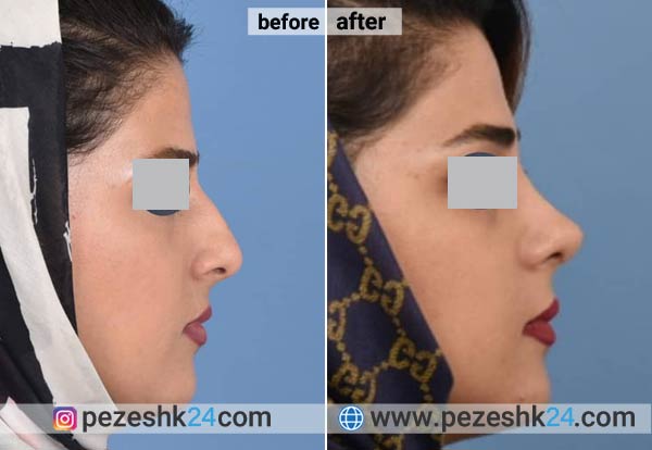 عکس قبل و بعد عمل بینی دکتر خوش رفتار اهواز