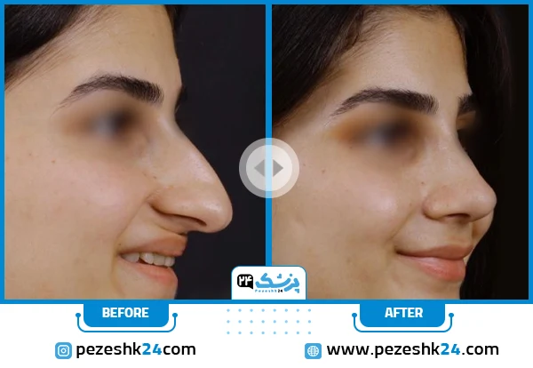 قبل و بعد عمل بینی