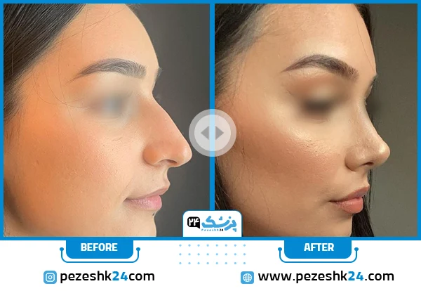 قبل و بعد جراحی بینی