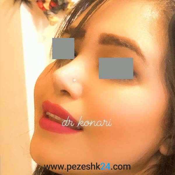عمل بینی در شاهرود