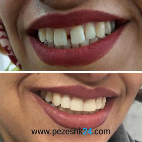 نمونه کامپوزیت دندان دکتر لیلا کریمی در شیراز 2