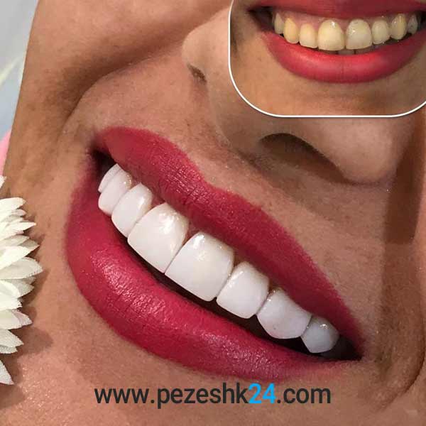 نمونه کامپوزیت دندان دکتر رنجبر در شیراز 3