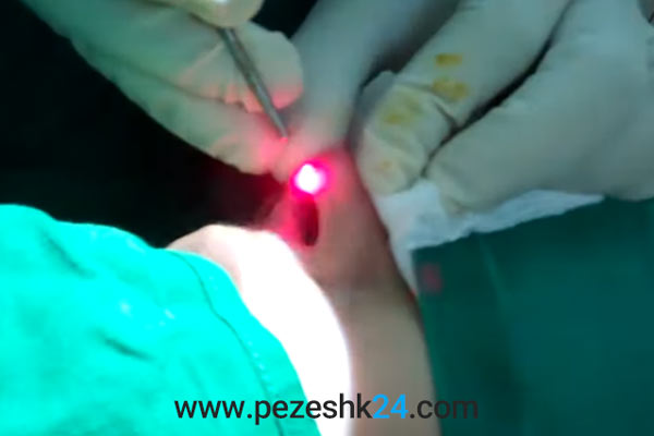 عمل بینی ترمیمی با لیزر