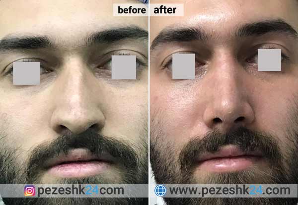 نمونه جراحی بینی دکتر بذری در شاهرود 4