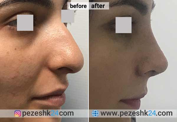 نمونه جراحی بینی دکتر بذری در شاهرود 3