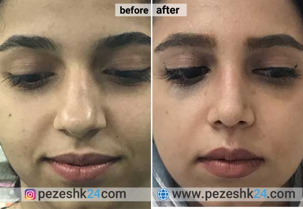 نمونه جراحی بینی دکتر بذری در شاهرود 2