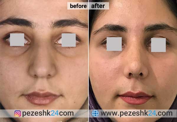 نمونه جراحی بینی دکتر بذری در شاهرود 1