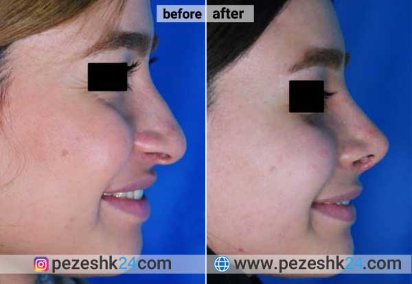 نمونه جراحی بینی دکتر اسمعیلی نژاد در شاهرود 1