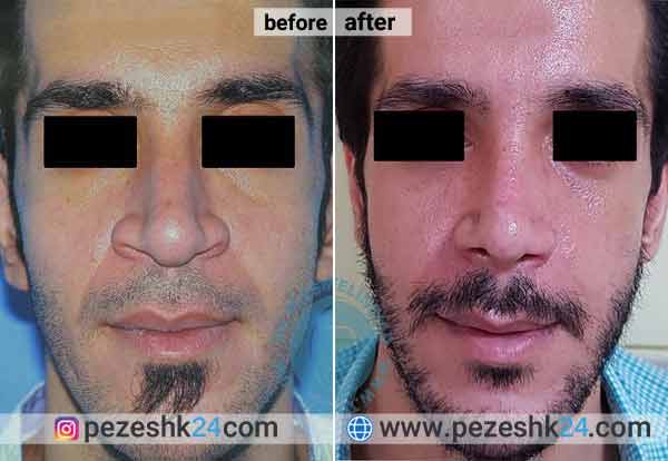 نمونه جراحی بینی دکتر اسمعیلی نژاد در شاهرود 3