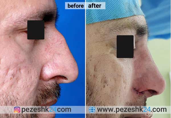 نمونه جراحی بینی دکتر اسمعیلی نژاد در شاهرود 4