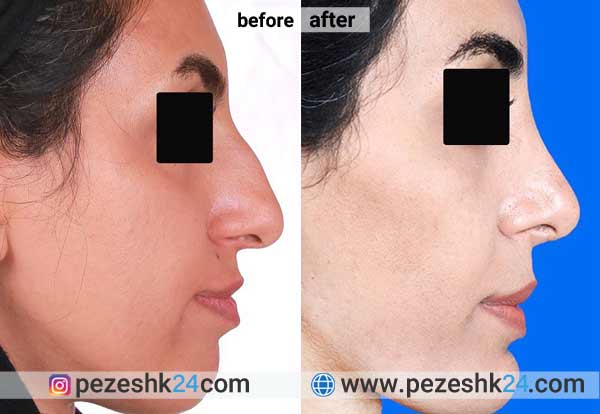 نمونه جراحی بینی دکتر اسمعیلی نژاد در شاهرود 2