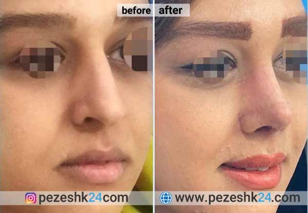 نمونه جراحی بینی دکتر کاردر در شاهرود 1
