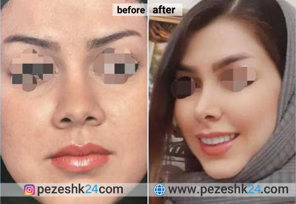 نمونه جراحی بینی دکتر کاردر در شاهرود 3