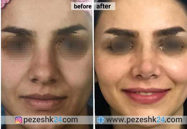 نمونه جراحی بینی دکتر کاردر در شاهرود 4
